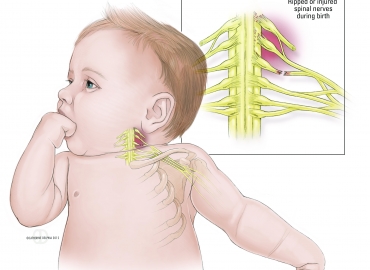 Doğumsal Brakial Pleksus Yaralanması