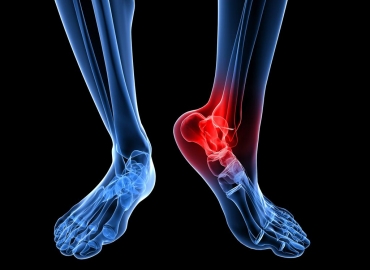 Ayak Bileği Protezi