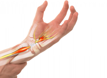 Karpal Tünel Sendromu