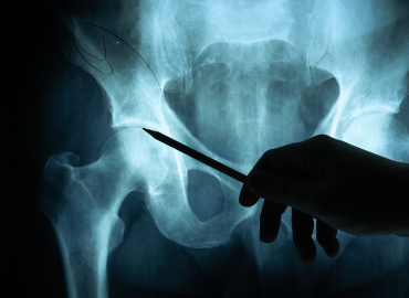 Kalça Osteotomisi (Ganz)