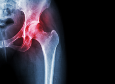 Kalça Kireçlenmesi